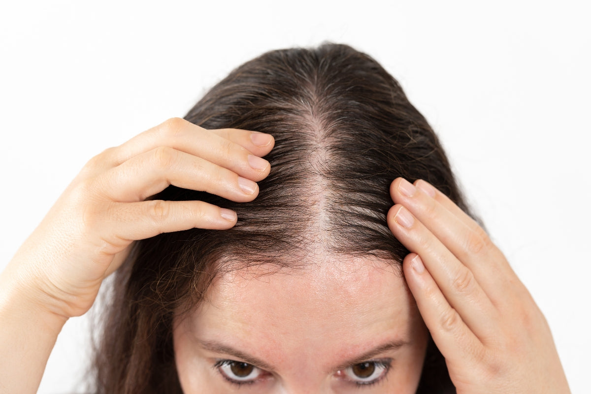 A women is showing her scalp to the camera showing her hair loss.