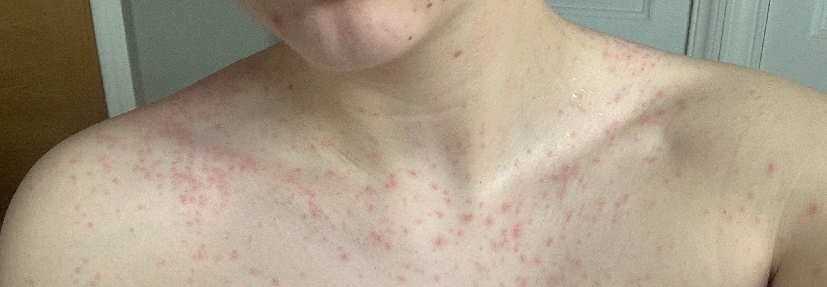person with skin irritation showing as red rash and hives on neck and décolletage  